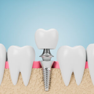 One-Day Dental Implants