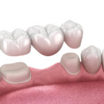 dental crowns and bridges