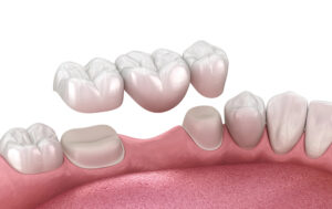 dental crowns and bridges