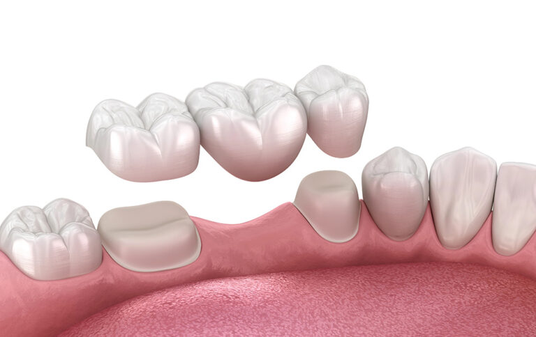dental crowns and bridges