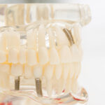full-arch dental rehabilitation Dental Implants