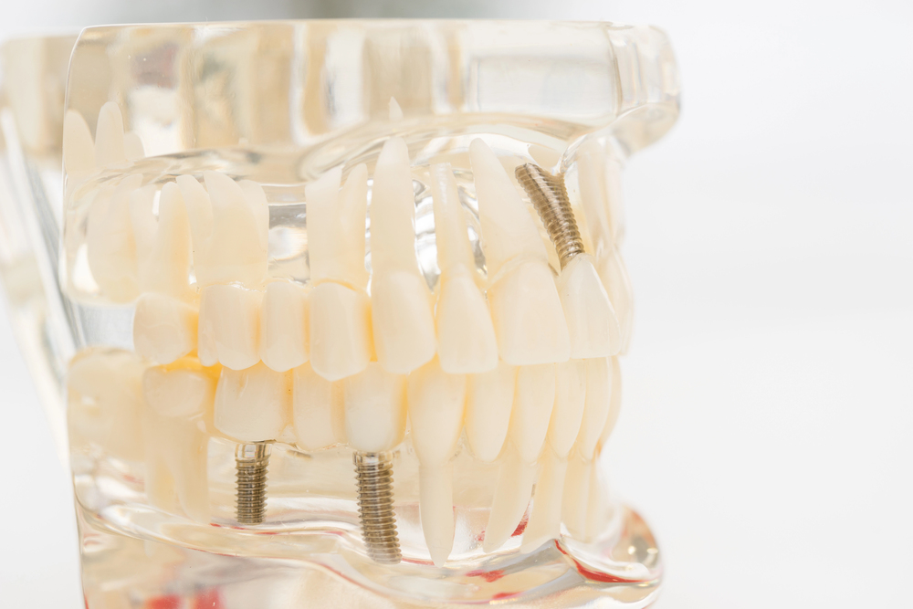 full-arch dental rehabilitation Dental Implants